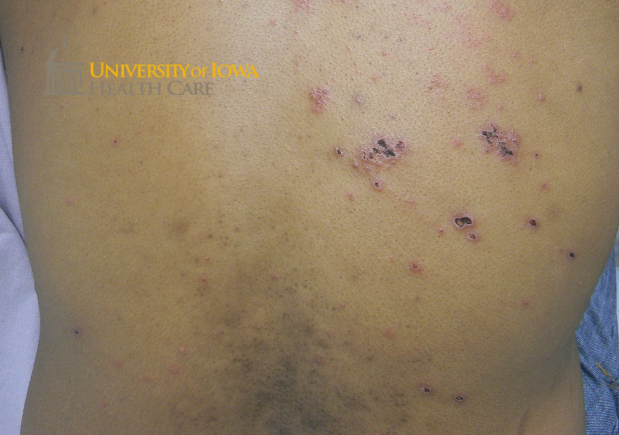 Many pink papules and vesicles, some with central erosion and some with heme-crusting on the back. (click images for higher resolution).